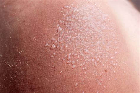 Sun Blister: Here's How to Tell If You Have One, and How to Treat It ...