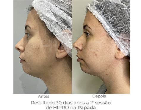 Hipro Antes E Depois Barriga - Conheça o poder do Ultrassom Microfocado Hipro!
