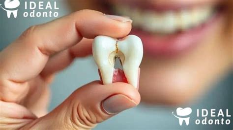 Tck Quebrando O Dente - Soluções para dente quebrado: o que fazer em casos de emergência?