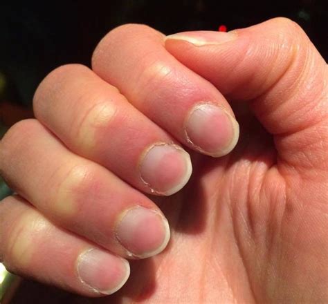 What Causes Red Fingernail Beds - Design Talk