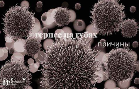 Герпес на губах. Как вылечить герпес на губах быстро
