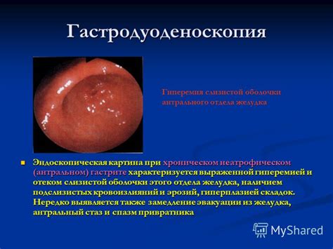 Презентация на тему: "Хронические гастриты Доцент кафедры факультетской ...