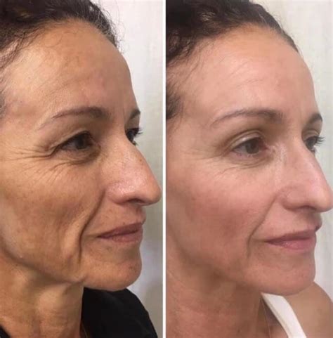 ProCell Microchanneling - Asheville - Mountain Radiance MedSpa