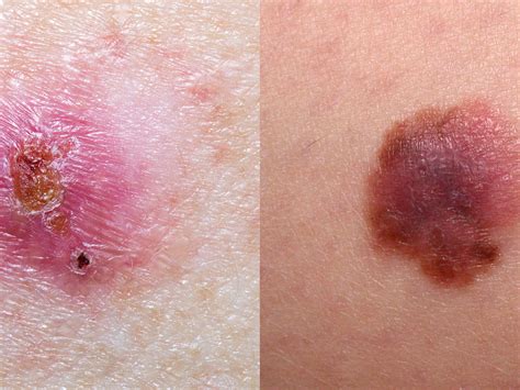 basal cell carcinoma  leg