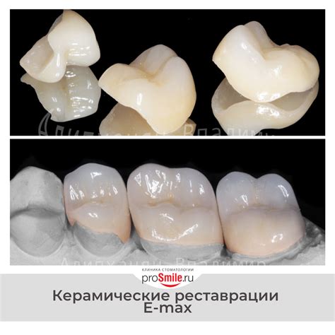 Лечение кариеса в Москве. Пломбы на зуб - стоматология Просмайл.Ру