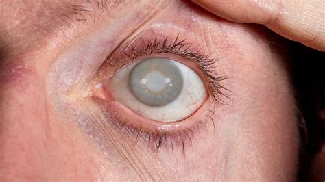 Cataract Surgery by Dr. Surbhi Kapadia in Vadodara