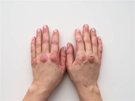 Psoriasis Awareness Month — Advanced Dermatology & Aesthetic Medicine