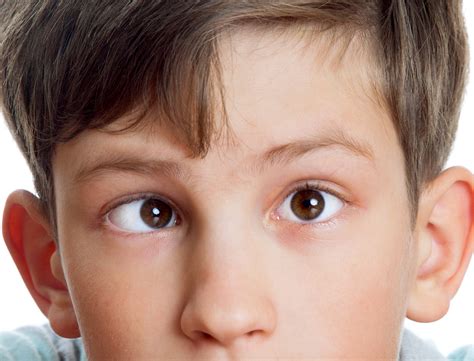 Strabismus | Dr Qaisar Ahmed MD, DHMS | Best | Homeopathic Doctor | KPK