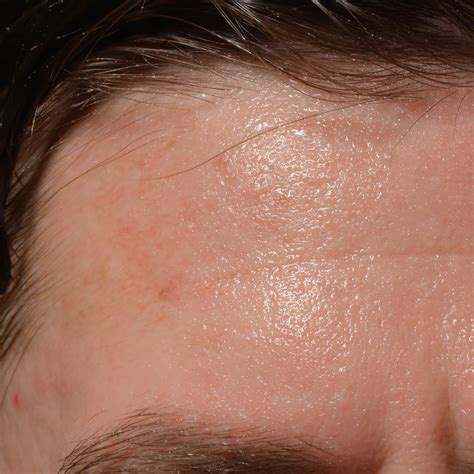 how to stop excessive sweating on face 10