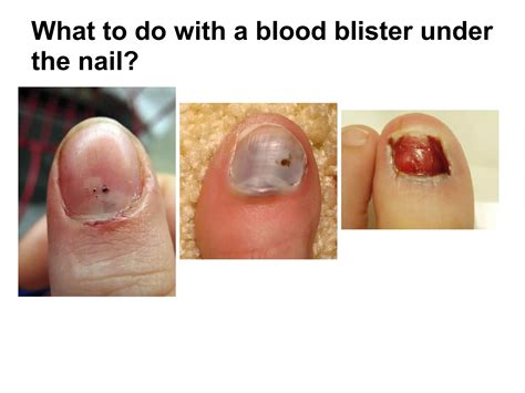 Nail injuries | PDF