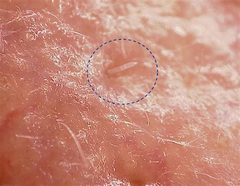 Acaro Na Pele De Bebe - Ácaros que vivem na nossa pele podem virar parte do organismo humano ...