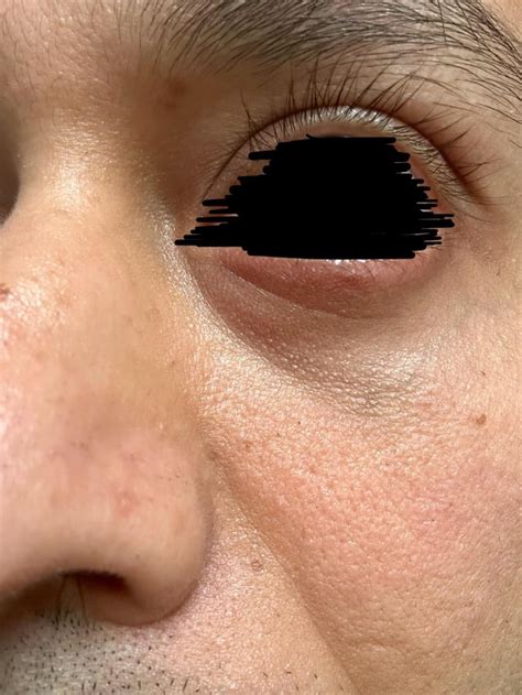 rough  patchy skin  forehead  cheeks rplusskincare