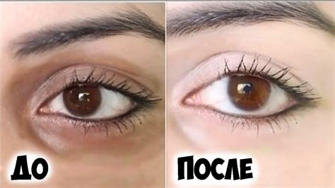 Как убрать мешки под глазами? 5 способов убрать мешки под глазами в ...