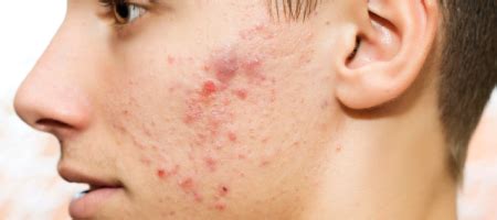 ACNE - Skin Health Institute