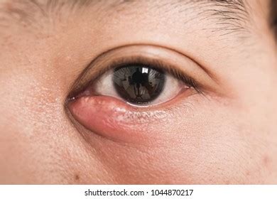 Hemorrhage Eye Woman Bruising Cornea Macro Stock Photo (Edit Now ...