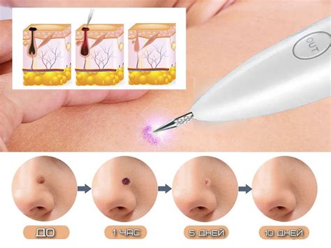 Прибор для удаления бородавок и папиллом (Mole Freckle Removal Pen ...