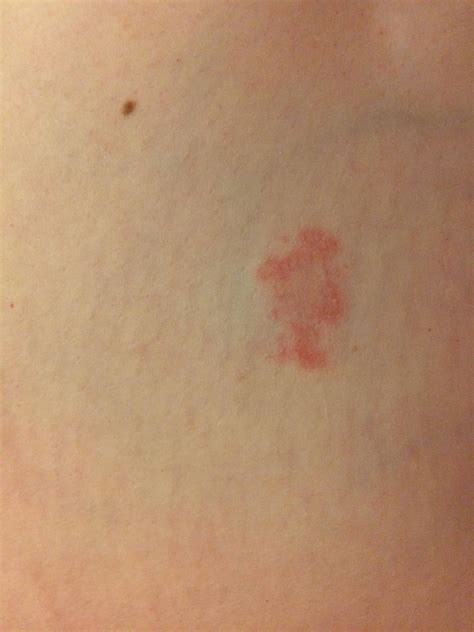 Red, non-itchy rash on inner thigh. : r/AskDocs