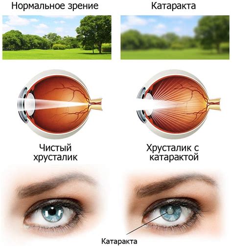 Катаракта — стадії розвитку та методи лікування - Офтальмологічні ...