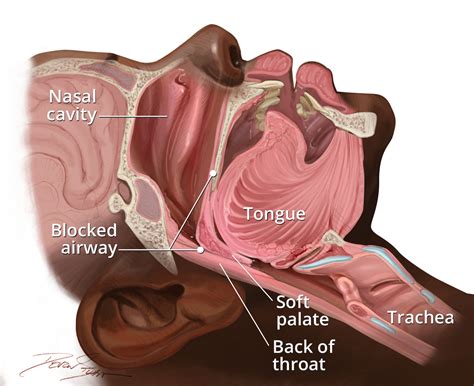 sleep apnea   risk factors nhlbi nih