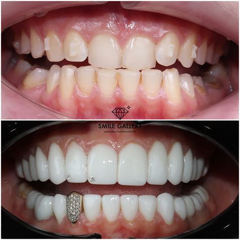 Вставить виниры в Новосибирске недорого и быстро | стоматология Smile ...