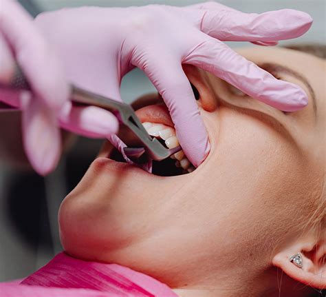 Post-Op Tooth Extraction Treatment in Yorba Linda, CA