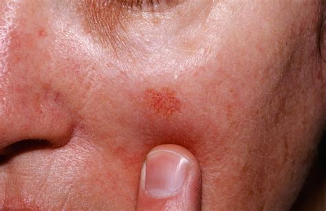 actinic keratosis  symptoms actinic keratosis treatment