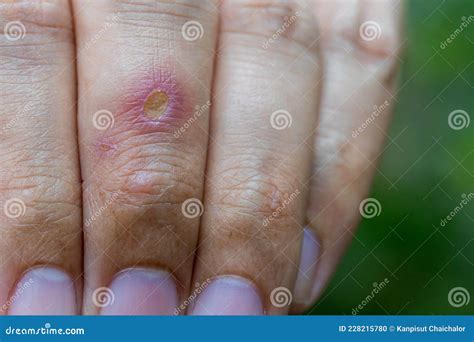 Paronychia, Swollen Finger With Fingernail Bed Inflammation Due To Bacterial Infection On A ...