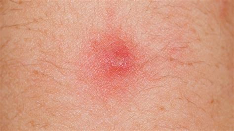 mengenal  jenis bisul  membahayakan tubuh penyebab