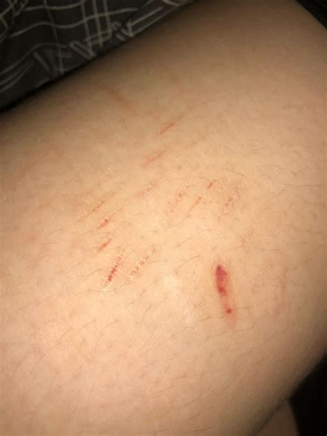 baby scars rselfharmscars