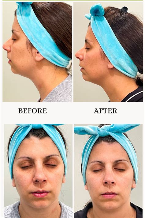 NuFACE Trinity Review - Later Ever After, BlogLater Ever After – A ...