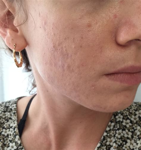 Will my scars heal with time? – Acne Scars – Acne.org Forum