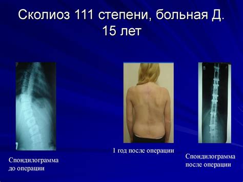 Профилактика и лечение нарушения осанки и сколиоза у детей ...