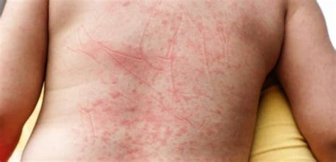 photo-of-Dust-Mite-irritation-and-allergies - Pest Hacks