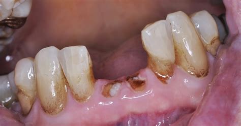 Ask Dr. Spindel: Should a tooth thats broken to the gum line be fixed?