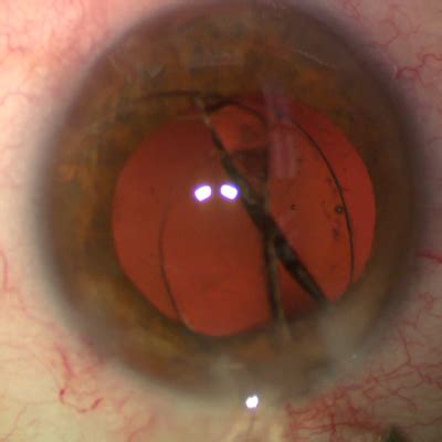iol exchange  eyeworld