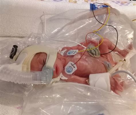 SA's smallest surviving micro-premature baby discharged