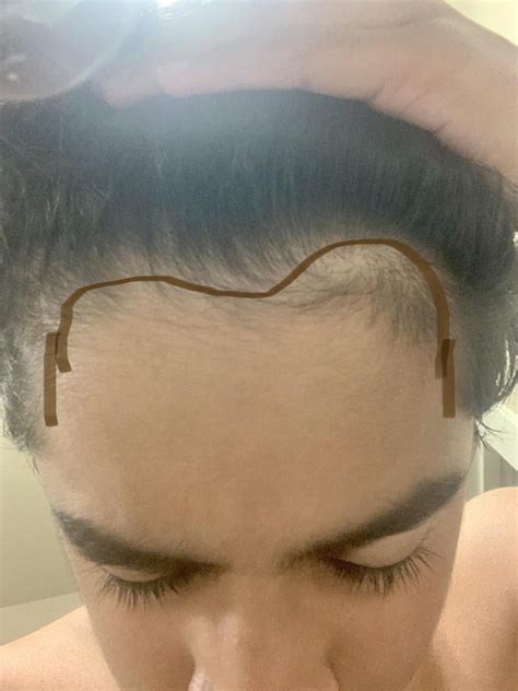 Why is my hairline changing? I’m noticing my left side is thinning, and