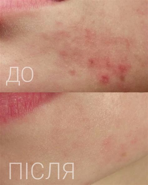 Крем допоміг справитися з дуже сильним висипом | MAKEUP Club