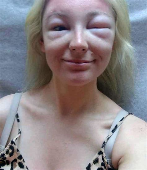 Allergic Reaction Face Swelling