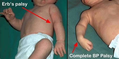 Erb's palsy causes, symptoms, diagnosis, prognosis & Erb's palsy treatment