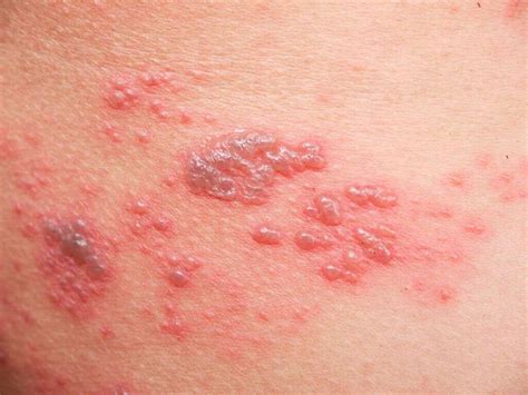 varicella   varicella