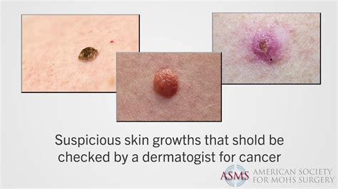 Why Are Regular Checkups Needed after Having Skin Cancer? | ASMS - YouTube