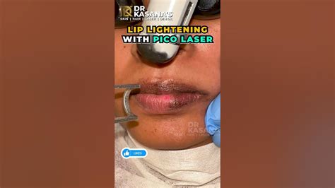 lip lightening  pico laser  dr kasana clinic youtube