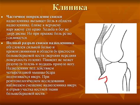 Растяжение связок коленного сустава