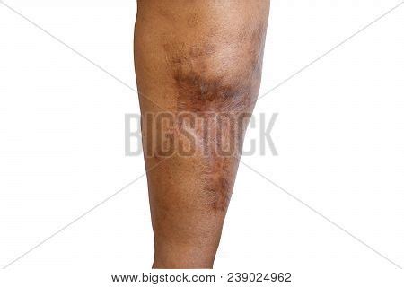 Large Scarring Occurs Image & Photo (Free Trial) | Bigstock