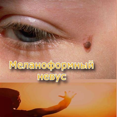 Меланоформный невус - это доброкачественное пигментированное ...
