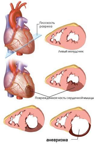 Что такое аневризма левого желудочка и что с ней делать?