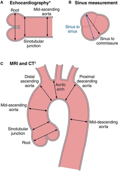 2022 ACC/AHA Guideline for the Diagnosis and Management of Aortic