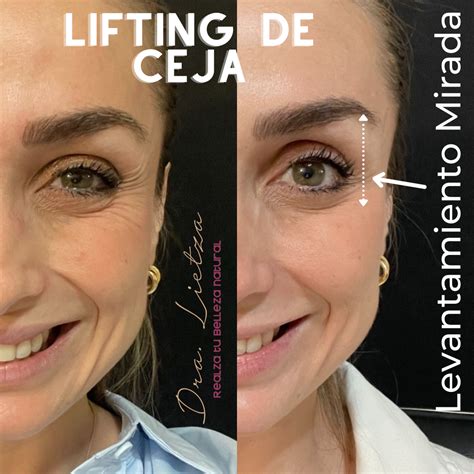 Botox Levanta O Olhar - Resultados de Botox - Fotos Antes y Después - Dra Lietza - Salud y Belleza