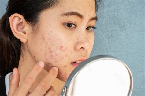 Let's treat you acne with Perfect Aesthetics Acne Treatment | Perfect ...